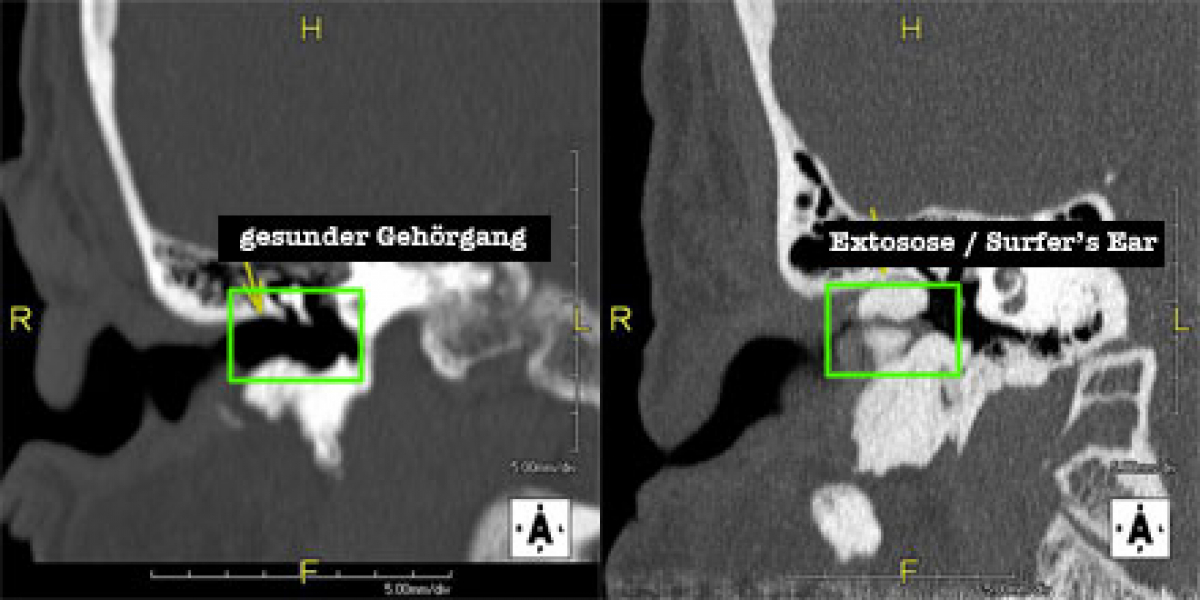 Exostose - Surfer Ohr